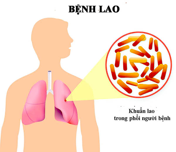 Bệnh lao, nguyên nhân và cách phòng ngừa